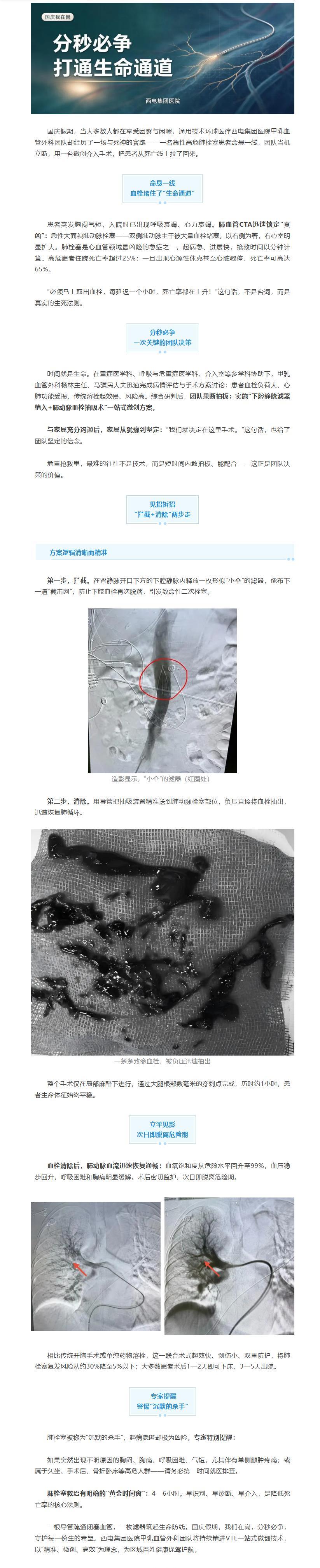 西电集团医院甲乳血管外科分秒必争，为急性高危肺栓塞患者打通“生命通道”.jpg